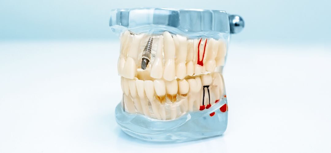 A dental implant teaching tool that includes the whole mouth.