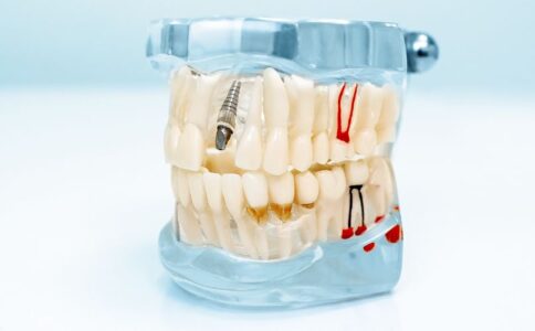 A dental implant teaching tool that includes the whole mouth.