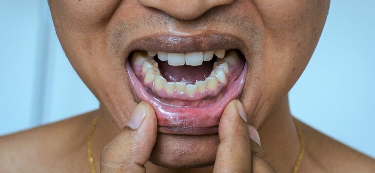 Gingivitis 101: Recognizing The Early Signs &Amp; Symptoms