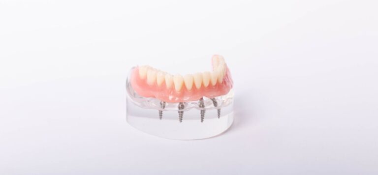 Who Is A Good Candidate For All-On-4 Dental Implants?